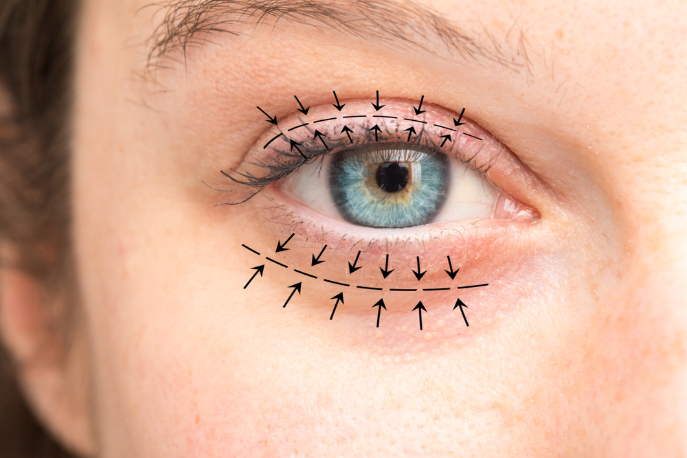 eye marked for eyelid surgery