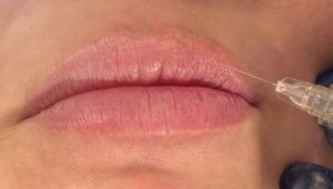 Close Up of Patient Receiving Lip Injections