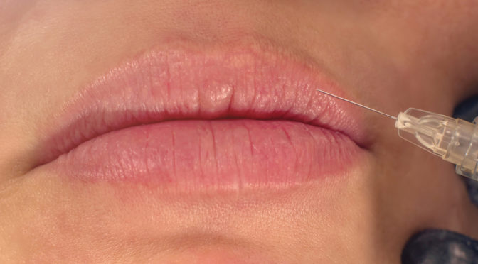 Close Up of Patient Receiving Lip Injections