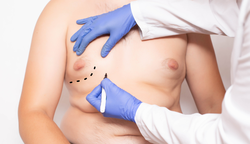 Doctor Marking Chest for Gynecomastia Surgery