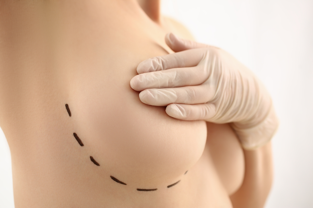 What You Need to Know About Breast Implant Removal