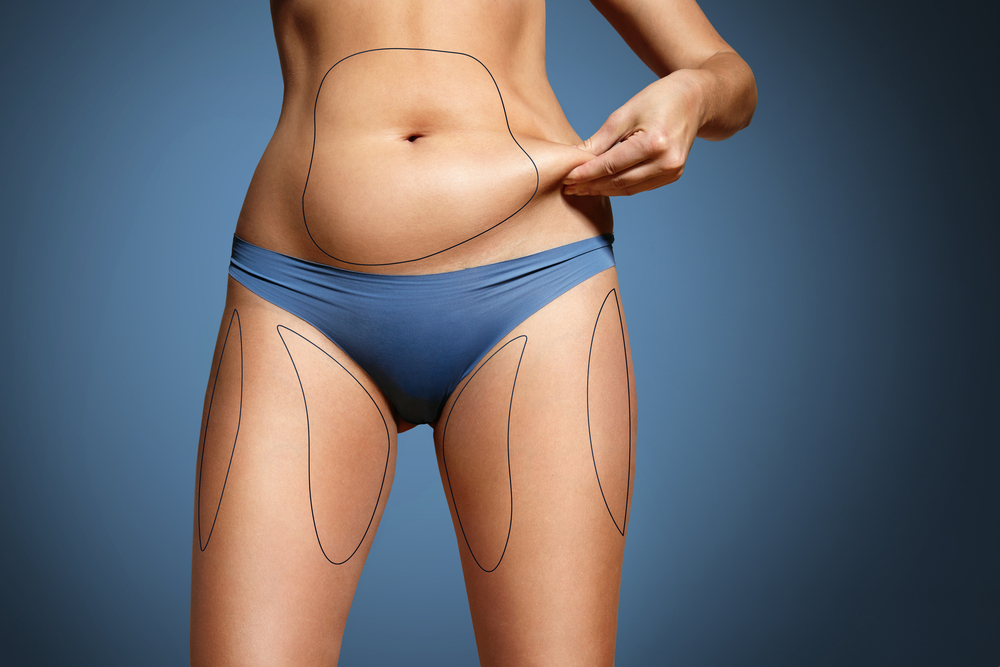 Combining Liposuction With a Tummy Tuck - Iconic Plastic Surgery