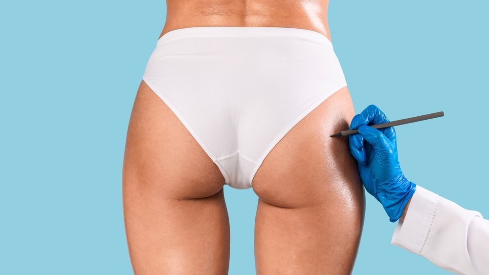 Everything You Need to Know About the Brazilian Butt Lift - Iconic Plastic  Surgery