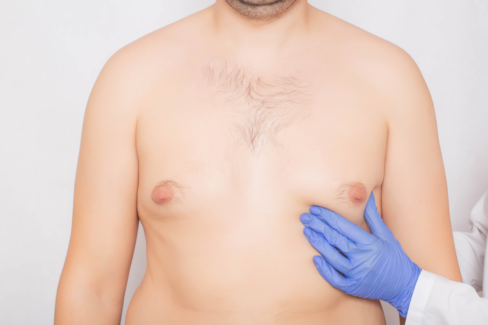 Get Fit for Summer With Gynecomastia Surgery