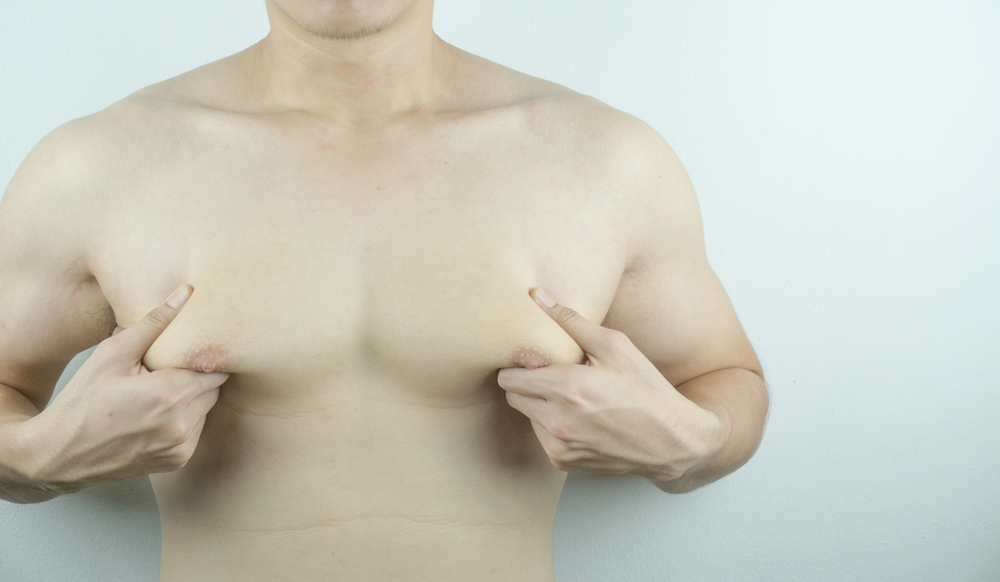 How to Tell If You Have Gynecomastia